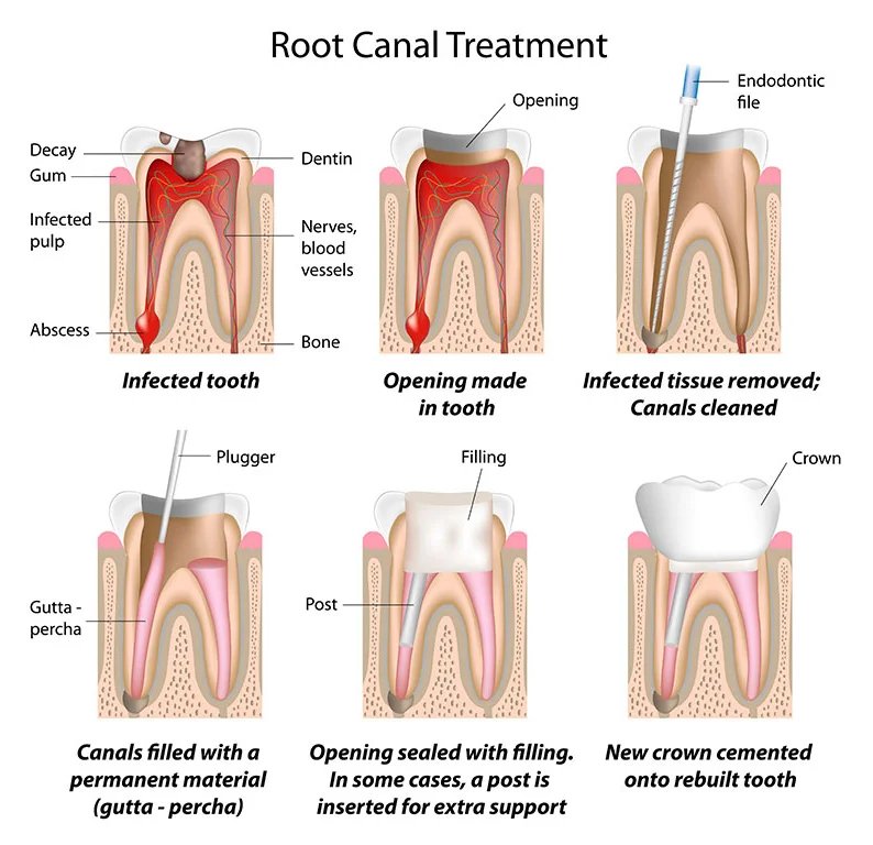root canal treatment westville