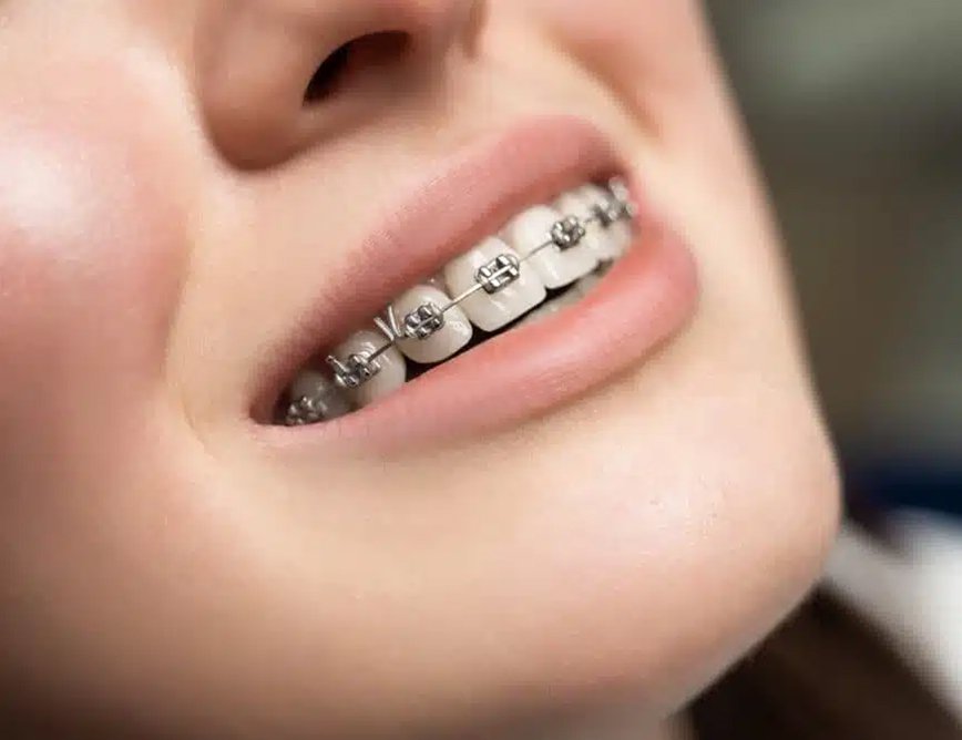 teeth braces westville