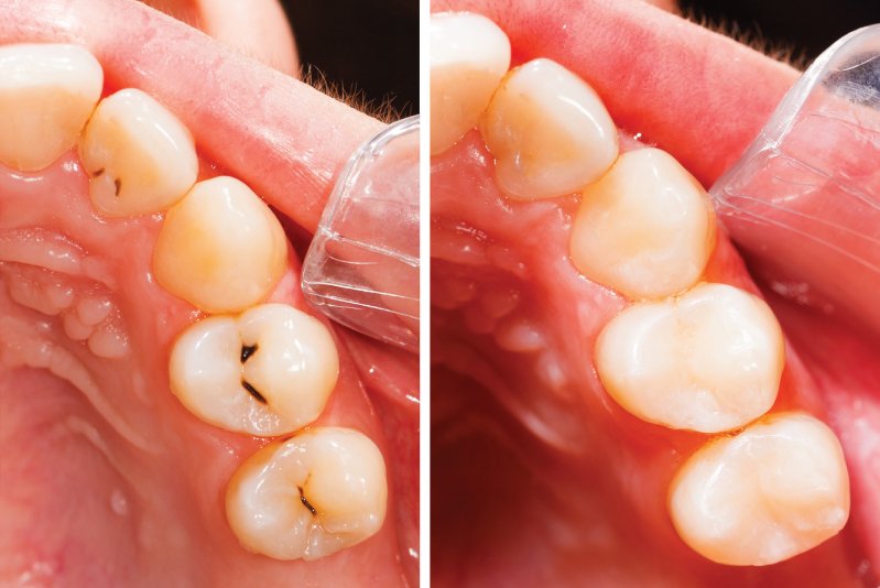 tooth cavity filling westville